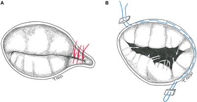 Surgical Techniques for Tricuspid Valve Disease